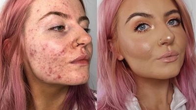 امرأة تكشف سر تغطيتها حبوب الشباب بنجاح (صور)