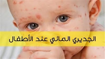 أعراض الإصابة بـ«الجديري المائي» وطرق العلاج والوقاية (فيديو)