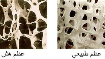 4 أنواع من الفيتامينات والمعادن تقي من هشاشة العظام