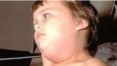 للأمهات.. 3 أعراض تؤكد إصابة طفلك بالغدة النكافية