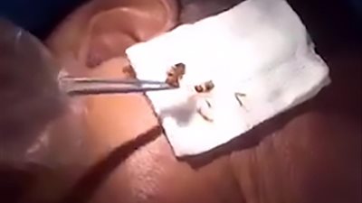 طبيب يزيل صرصارا حيا من أذن رجل (فيديو)