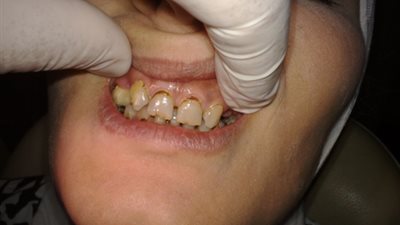 دراسة: نخور الأسنان تحمي من السرطان!