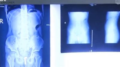 جراحة غريبة لطفل ابتلع عشرات الكرات المغناطيسية (فيديو)