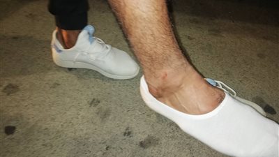 شاهد تورم قدم حسين الشحات عقب مباراة سيمبا