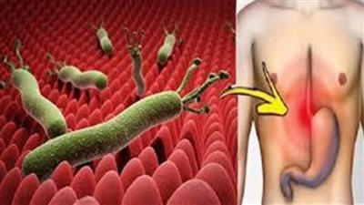 4 أعشاب لعلاج جرثومة المعدة