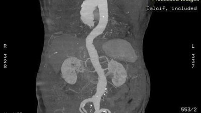 فريق طبي ينجح في إجراء عملية تمدد بالشريان بتأمين شبرا الخيمة