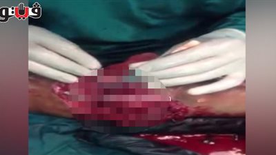 طبيب ينجح في إعادة ذراع مواطن بعد بترها بساعات في دمياط (فيديو)