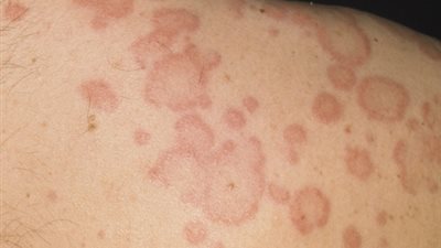 «الناظر»: الصيام يشفي مرضي الأرتيكاريا والكلى والجهاز البولي