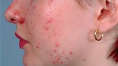 وصفة بسيطة تخلصك من حب الشباب في يوم واحد