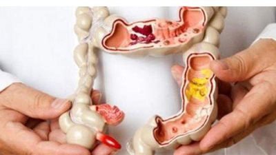 أعراض القولون العصبى وأسبابه وطرق العلاج