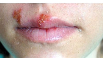 كل ما تريد معرفته عن مرض الهربس الجلدي.. الأسباب والعلاج
