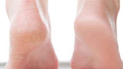 وصفة طبيعية للتخلص من تشقق القدمين نهائيًا