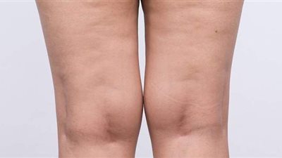 وصفة خل التفاح لعلاج السيلوليت بطريقة فعالة