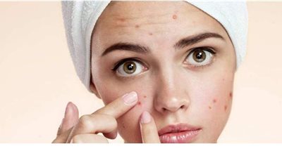 وصفة طبيعية للتخلص من حب الشباب