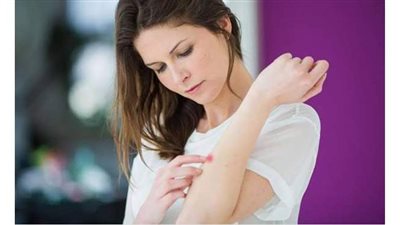 أعراض الذئبة الحمراء.. الطفح الجلدي والتحسس الضوئي أبرزها