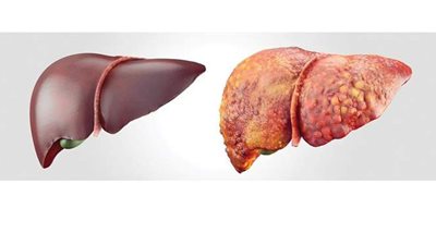 أعراض ارتفاع إنزيمات الكبد وأسبابه وطرق العلاج