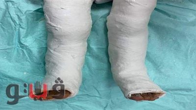 فريق طبي بجامعة طنطا ينجح في  علاج نادر  بقدم طفل | صور