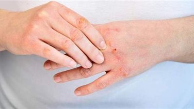 طبيب: مرض الصدفية يصيب من ١ إلى ٣% من البشر