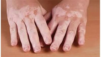 تعرف على أفضل طرق علاج مرض 