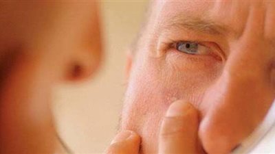 أعراض مرض الإيدز.. تشبه أعراض الإنفلونزا في مراحله الأولى