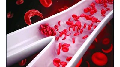 الأنيميا المنجلية.. الأعراض وطرق العلاج