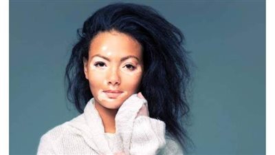 5 معلومات عن مرض البهاق وطرق علاجه