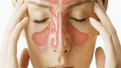 أعراض حساسية الجيوب الأنفية