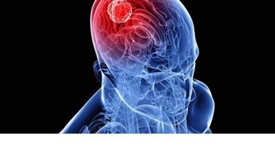 اعراض ورم المخ.. ٧ علامات تنذر بوجود ورم في المخ