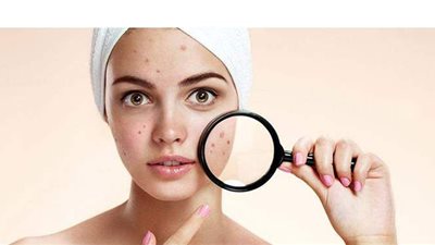 3 مواد طبيعية تخلصك من حب الشباب