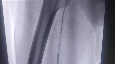 نجاح عملية توسيع بالوني بالقسطرة الطرفية لمريض بمستشفى المنصورة الدولي