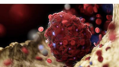 تحديد سبب جديد لجلطات الدم في حالات كورونا الشديدة