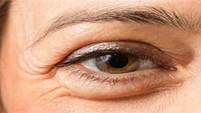 تعرف على أسباب انتفاخ تحت العين وأفضل طرق العلاج