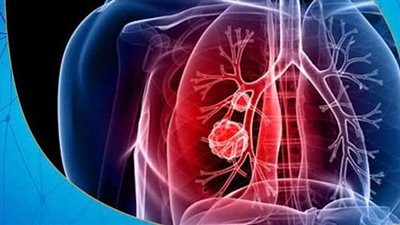 اعراض جلطة الرئة