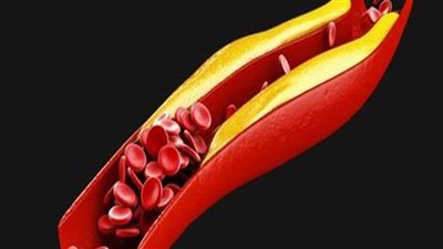 أعراض الإصابة بارتفاع الكوليسترول في الدم  وطرق العلاج