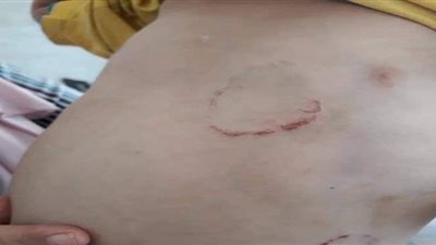 القومي للطفولة بالقليوبية: زوج الأم كان يعذب طفلتي زوجته دون تدخل والدتهما