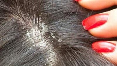 ٣ طرق طبيعية للتخلص من القمل سريعًا