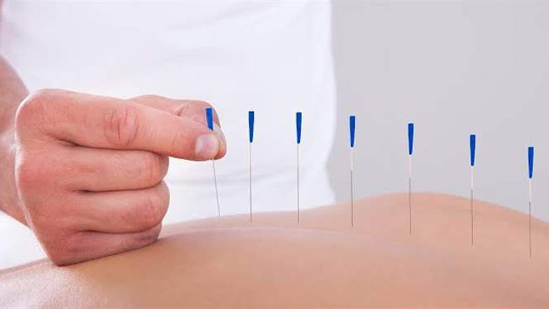 العلاج بالإبر الصينية