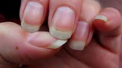 خطر فطريات الأظافر على مرضى السكري وطرق الوقاية منها