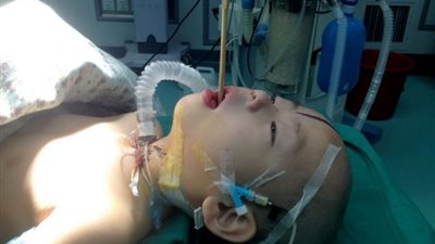 بالصور.. عصا خشبية تقطع فم طفل وتصل إلى المخ