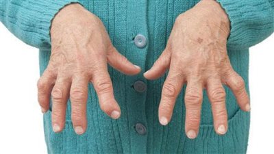 اعراض مرض الروماتويد | 7 مضاعفات لمرض الروماتويد.. احذرها