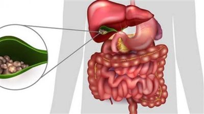 علاج حصوات المرارة | 4 مضاعفات للإصابة بحصوات المرارة