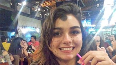 بالصور.. «وحمة» تغطى 80% من جسد فتاة