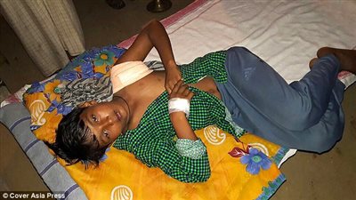 بالصور.. أطباء ينقذون صبيا بإزالة عصا اخترقت جسده