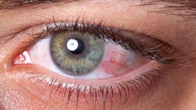 تعرف على العلاج الأمثل لأمراض العين