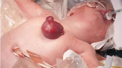 ولادة نادرة لطفلة في بريطانيا بقلب خارج جسمها