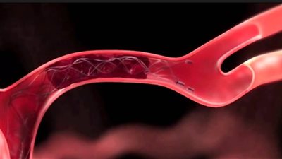 استشاري يوضح أنواع الجلطات الدموية وطرق الوقاية منها