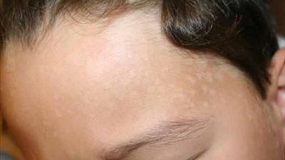 9 نصائح للوقاية من «التينيا» في فصل الصيف