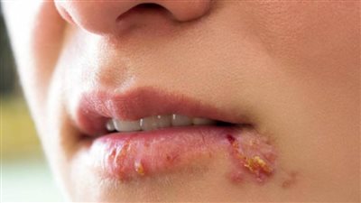 أعراض وأسباب مرض الهربس عند الأطفال