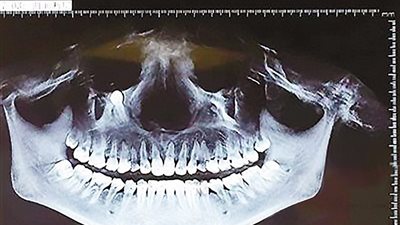 بالصور.. حالة غريبة لنمو «سن» أسفل عين امرأة