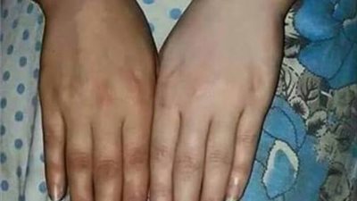 ماسك البيكنج بودر يخلصك من اسمرار اليدين نهائيًا